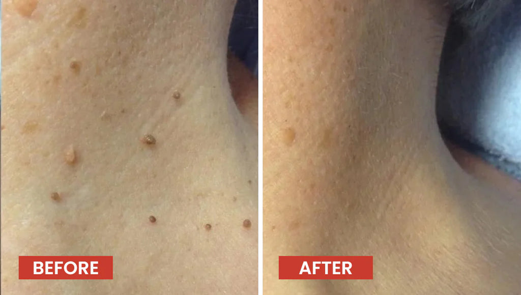 Pimple Patches 72 Pack - Hydrocolloid Acne Patches | Luxora